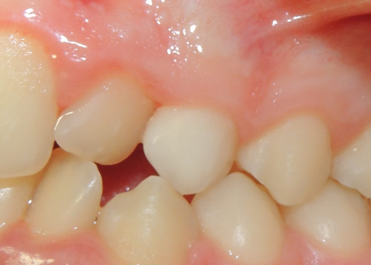 Zagoreo Damon,Impacted cuspid, no surgery, laser.